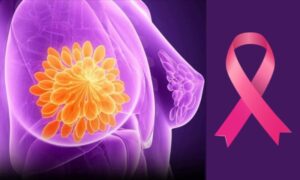 Breakthrough in Preventing Breast Cancer Recurrence